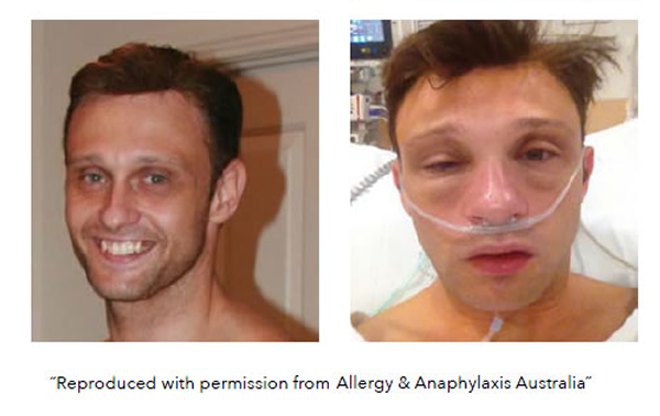 severe allergic man